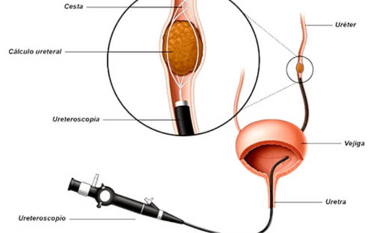 ureteroscopia-laser