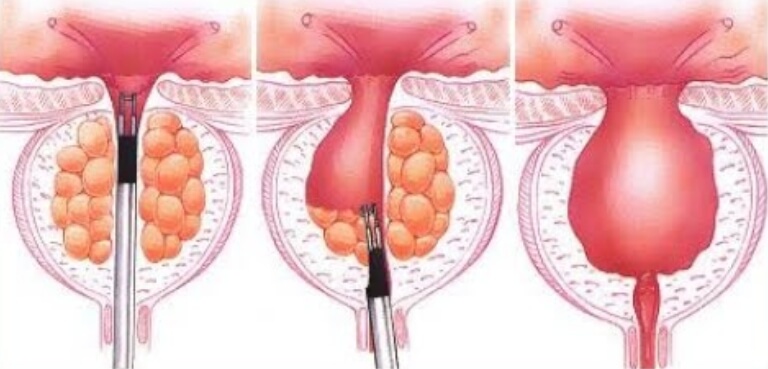 reseccion-bipolar-prostatica