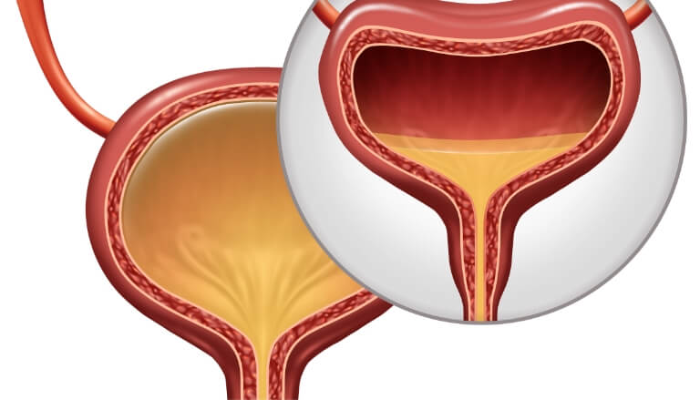 sindrome-de-vejiga-hiperactiva